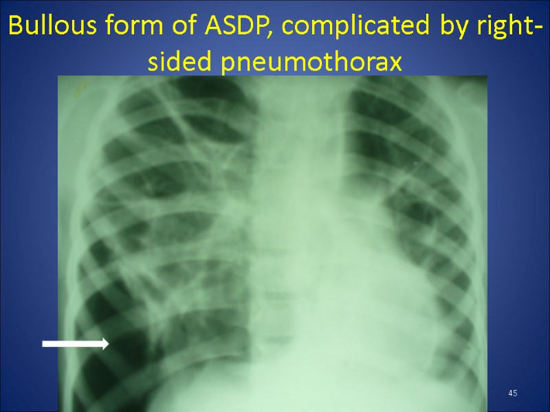 Bullous form of ASDP, complicated by right-sided pneumothorax 45